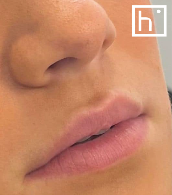 Augmentation des lèvres avant - hapiderm geneve