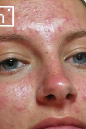 Hydrafacial acne before
