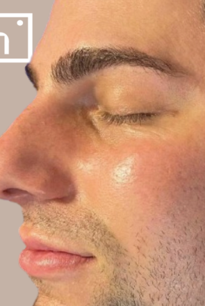 Hydrafacial glow after - hapiderm