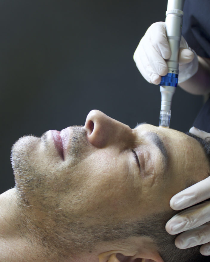 Microneedling homme chez hapiderm Geneve